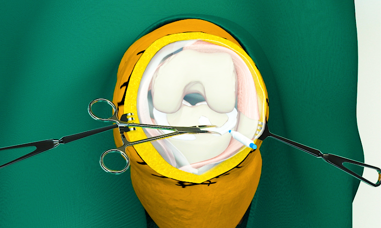 膝关节医疗手术三维动画